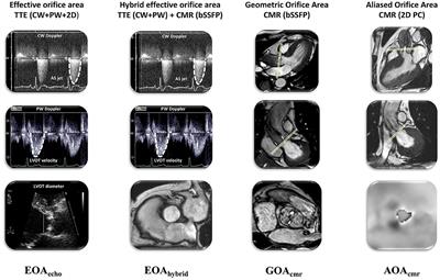 Aliased Flow Signal Planimetry by <mark class="highlighted">Cardiovascular Magnetic Resonance Imaging</mark> for Grading Aortic Stenosis Severity: A Prospective Pilot Study